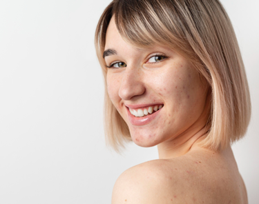 Trattamenti per la Pelle Grassa e l'Acne Estiva
