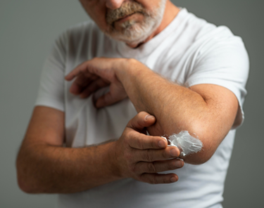 Ulcere cutanee: sintomi, cause e trattamenti per una guarigione efficace